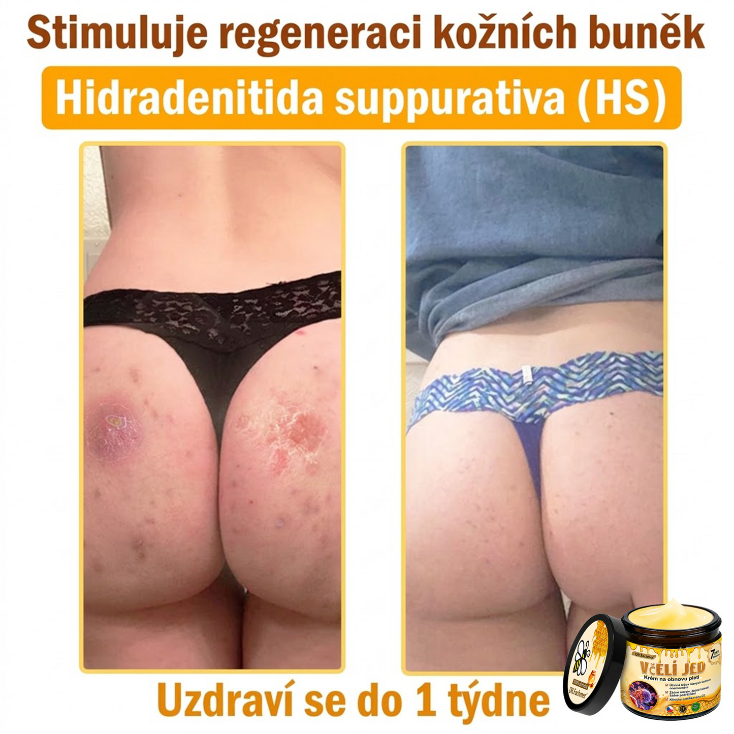 ⚡Dermatologicky a klinicky testováno👩‍⚕️DR.Fachmer®Bee Venom Krém na obnovení pleti🐝 pomáhá při léčbě kožních problémů, jako jsou: vrásky, jizvy, pigmentové skvrny, strie, akné, psoriáza, ekzém, kožní změny, podráždění, záněty a další kožní problémy.