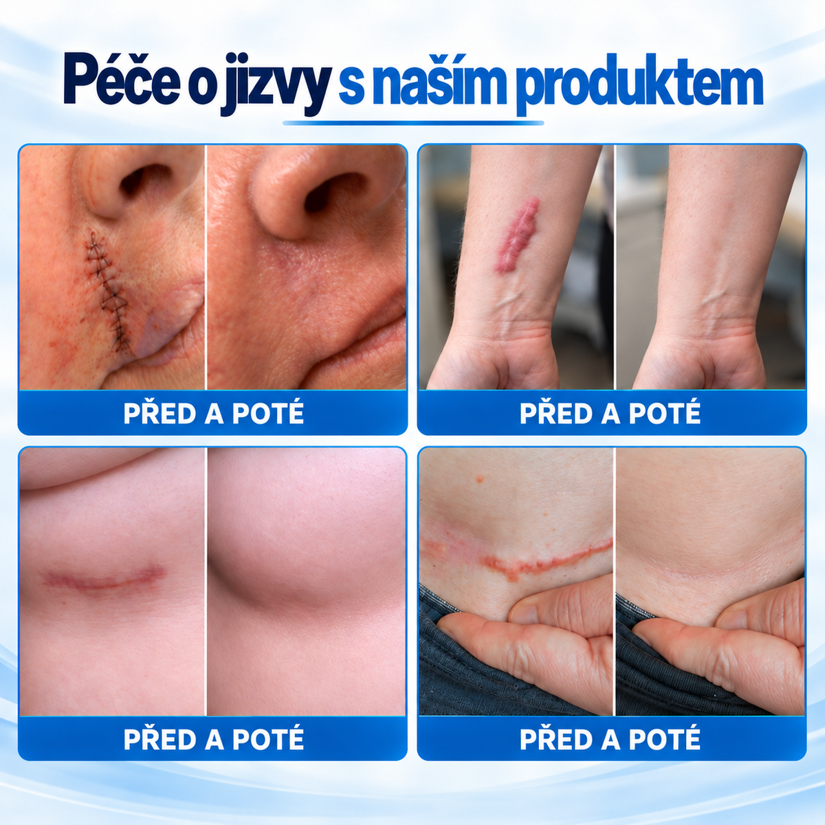 Dr.Fachmer®⭐Bio-regenerační mikrojehličková náplast na jizvy – silikonová péče s regeneračním proteinovým komplexem