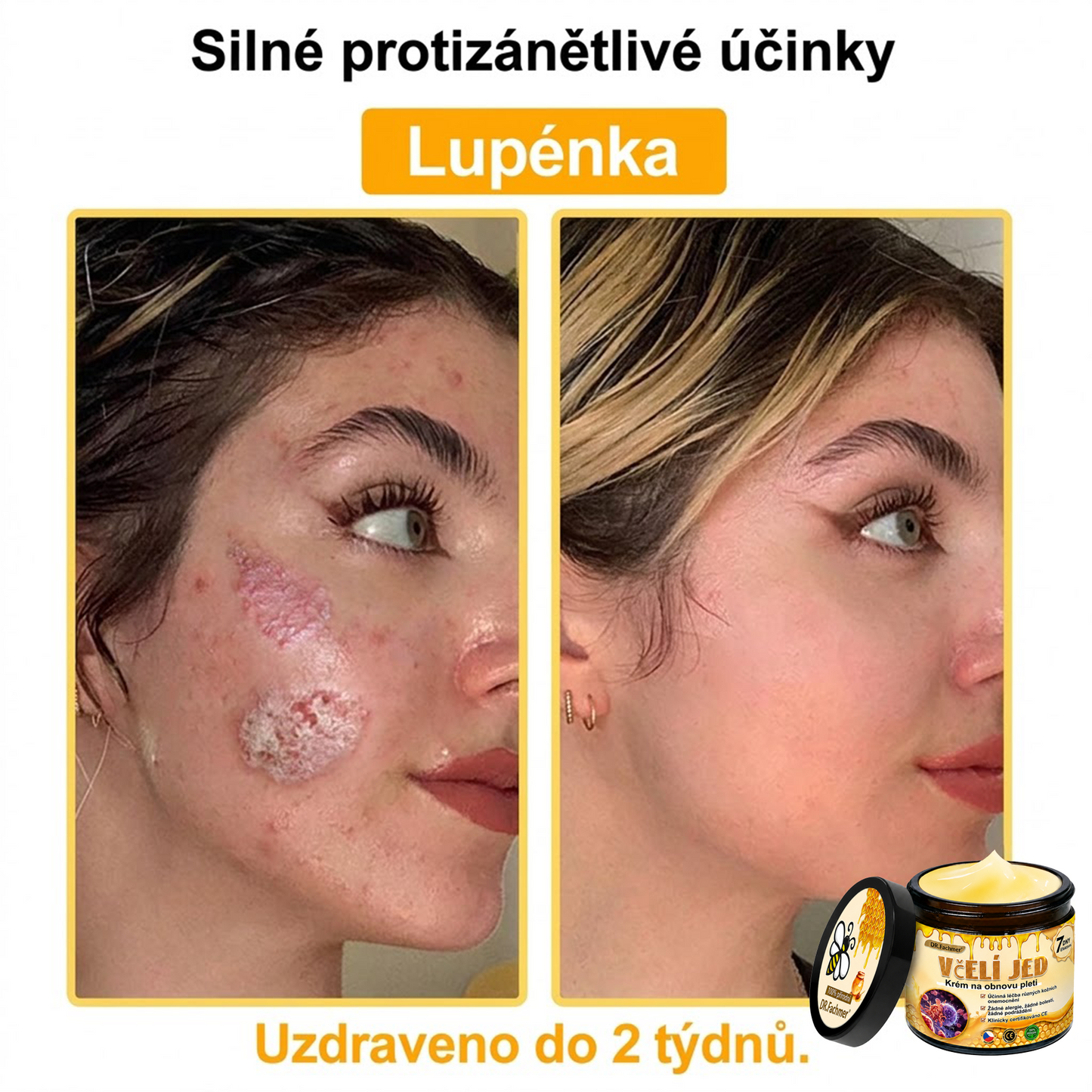 ⚡Dermatologicky a klinicky testováno👩‍⚕️DR.Fachmer®Bee Venom Krém na obnovení pleti🐝 pomáhá při léčbě kožních problémů, jako jsou: vrásky, jizvy, pigmentové skvrny, strie, akné, psoriáza, ekzém, kožní změny, podráždění, záněty a další kožní problémy.