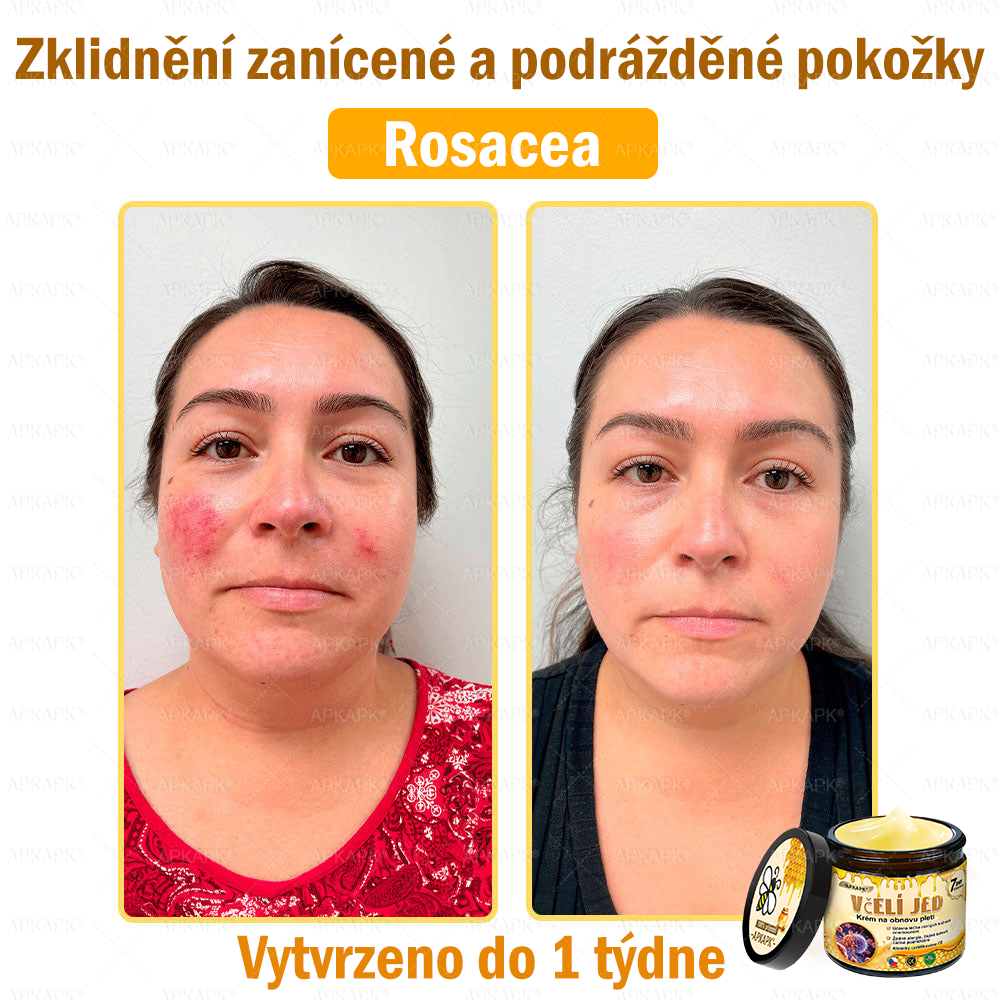 🐝🐝Dermatologicky a klinicky testováno👩‍⚕️DR.Fachmer®Bee Venom Krém na obnovení pleti🐝 pomáhá při léčbě kožních problémů, jako jsou: vrásky, jizvy, pigmentové skvrny, strie, akné, psoriáza, ekzém, kožní změny, podráždění, záněty a další kožní problémy.