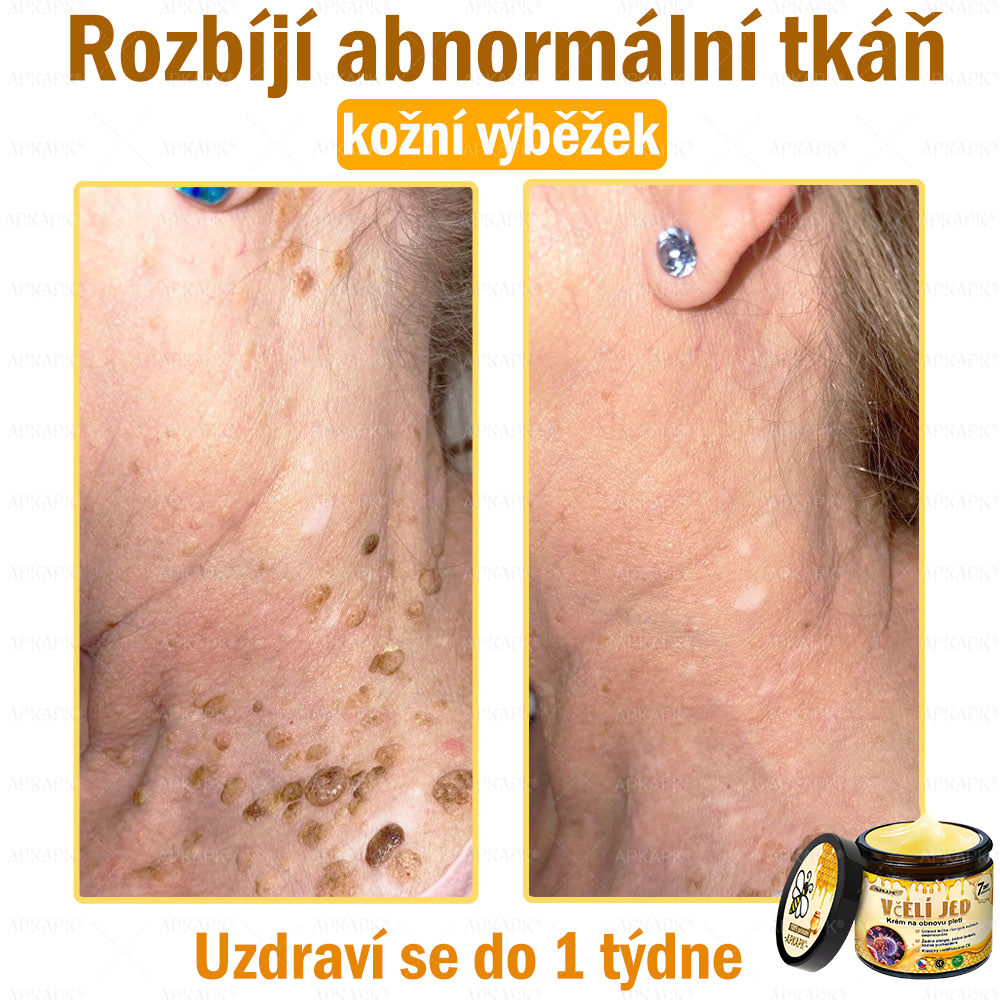 🐝🐝Dermatologicky a klinicky testováno👩‍⚕️DR.Fachmer®Bee Venom Krém na obnovení pleti🐝 pomáhá při léčbě kožních problémů, jako jsou: vrásky, jizvy, pigmentové skvrny, strie, akné, psoriáza, ekzém, kožní změny, podráždění, záněty a další kožní problémy.