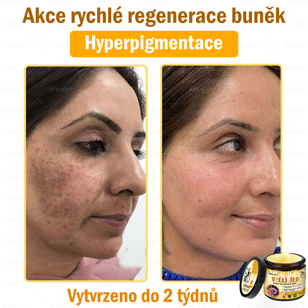 🐝🐝Dermatologicky a klinicky testováno👩‍⚕️DR.Fachmer®Bee Venom Krém na obnovení pleti🐝 pomáhá při léčbě kožních problémů, jako jsou: vrásky, jizvy, pigmentové skvrny, strie, akné, psoriáza, ekzém, kožní změny, podráždění, záněty a další kožní problémy.